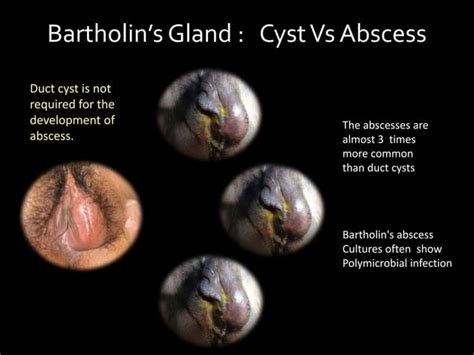 inflammation glande de skene|Skenes Gland: What Theyre For, Cyst Symptoms & Treatment